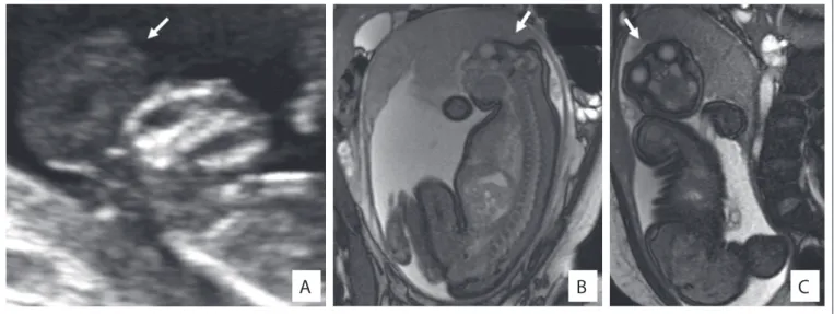 Figure 2. Two-dimensional ultrasound showing the proile of fetuses presenting exencephaly, i.e