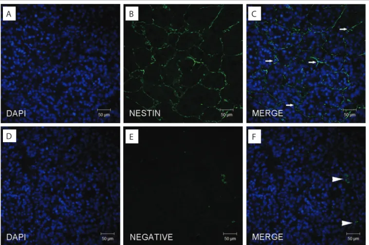 Figure 2. Nestin-positive endothelial cells in hepatocellular carcinoma. The upper row depicts nuclear staining with DAPI (A), nestin  staining in endothelial cells that form a liver sinusoid-like structure (B) and a merged image (C)