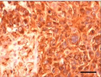 Figure 3. Nestin staining of the glioblastoma sample. 