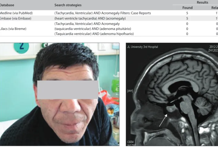 Figure 1. The patient exhibited the typical features of acromegaly, with  increased head circumference and pronounced lower jaw protrusion.