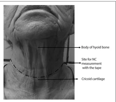 Figure 1. Neck circumference (NC) was measured just above the  cricoid cartilage and perpendicular to the long axis of the neck