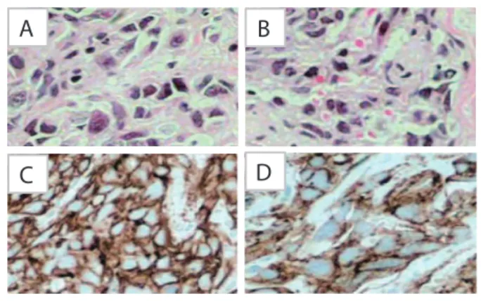Figure 1. Neoplasm composed of spindle cells showing  pleomorphic epithelioid eosinophilic cytoplasm and large  hyperchromatic nuclei (A and B)