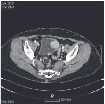 Figure 1. Abdominal computed tomography showing an  intraluminal polypoid mass of approximately 3 × 3.2 cm in  size with heterogeneous enhancement on the left lateral wall  of the urinary bladder.