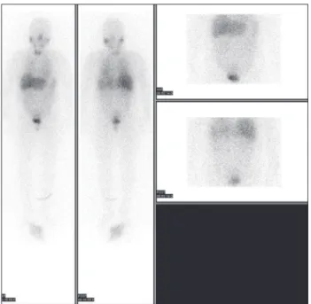 Figure 4. Immunohistochemical analyses revealing that the  tumor cells were positive for chromogranin A, S-100 and  synaptophysin
