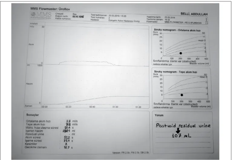 Figure 1. Preoperative urolowmetry showing obstructed voiding.