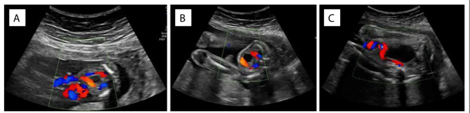 Figure 1. Imaging of the case at 18 weeks (1a) and 22 weeks (1b), and then at 32 weeks (1c), when the “disappearance” of one of the  umbilical arteries was noticed.