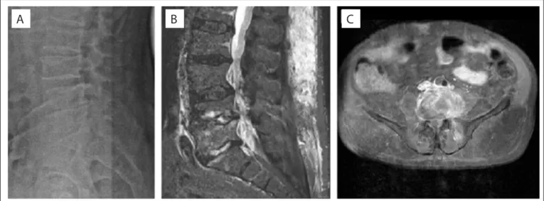 Figure 1. Radiography and magnetic resonance imaging (MRI) of lumbosacral spine. (A) Lateral radiograph showing irregular vertebral plates  of L4 and L5, and reduction of disc spaces L4-L5 and L5-S1