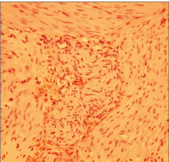 Figure 1. Hirschsprung disease: myenteric plexus lacking  ganglion cells (hematoxylin-eosin staining, 400 x).