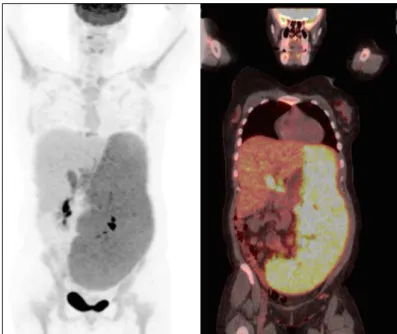 Figure 4. Small and few large lymphoid cells in splenic red pulp  (hematoxylin and eosin, x 200)