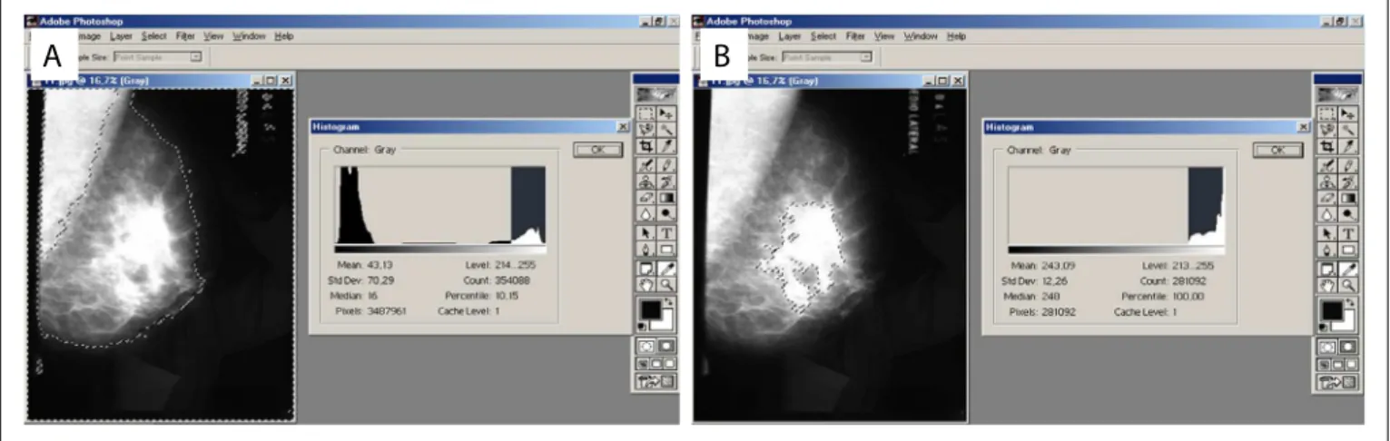 Figure 1. (A) Use of the “Lasso Tool” in Adobe Photoshop software, on a mammogram scan, for selection of the area to be calculated; 
