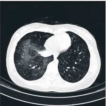 Figure 2. Computed tomography scan of the chest 