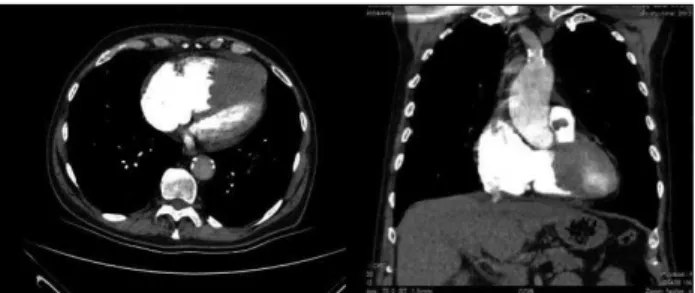 Figure 1. Contrast computed tomography pulmonary 