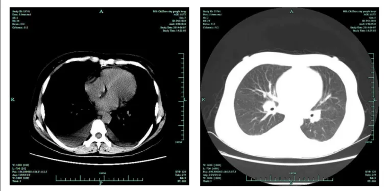 Figure 1. Computed tomography of the chest, revealing slight swelling of the mediastinal lymph nodes and a small amount of bilateral  pleural efusion, with slightly more on the right side than on the left.