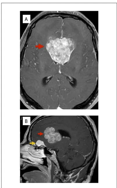 Figure 1. Magnetic resonance imaging of a patient with simultaneous  brain tumors: A - axial image showing ventricular tumor; B – sagittal  image showing two lesions: olfactory groove meningioma and  ventricular tumor.
