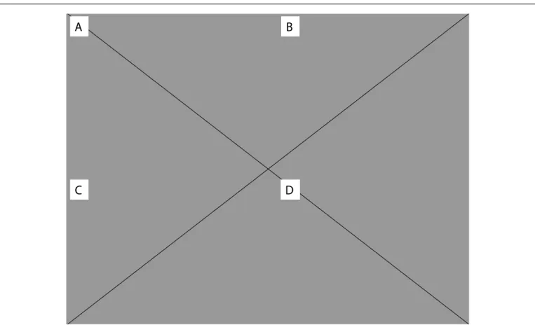 Figure 1. Bone marrow smears at the time of relapse of acute myeloid leukemia. A) Bone marrow presenting blastic cell iniltration, 20 X; 