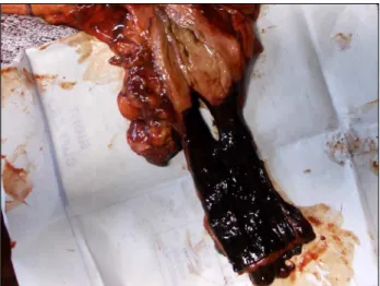 Figure 2. Gross examination of the distal esophagus showing  a longitudinal complete rupture 15 mm from the cardia
