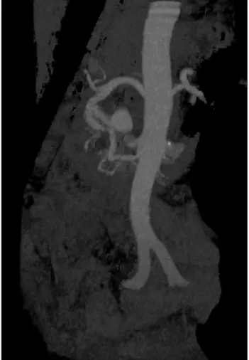 Figure 3. Postoperative computed tomography scan  (three-dimensional) showing residual illing of the right  gastroepiploic artery