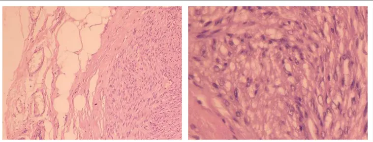 Figure 2. Histological sections revealing circumscribed appearance of the lesion, with proliferation of fusiform pattern and lack of  atypical forms