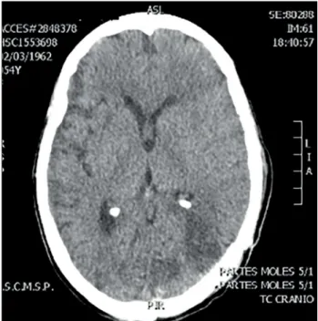 Figure 2. Axial computed tomography performed during the  postoperative period showing gross total resection.
