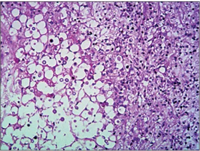 Figure 3. Histopathological analysis on the lesion. On the left side, the  deeper part of the lesion shows multiple fungi