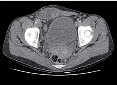 Figure 2. Macroscopic appearance demonstrating areas of  cystic and trabecular components.