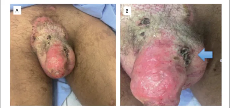 Figure 2. Genital ulcers following infection for genital  piercing. Several larvae found inside genital ulcers.