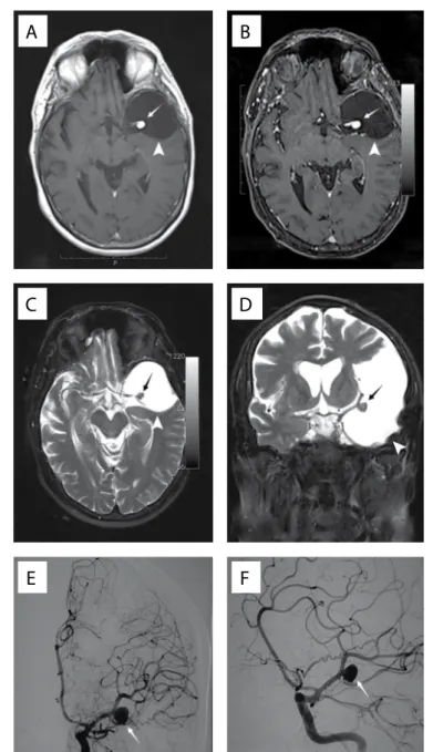 Figure 1. A) Axial T1-weighted non-contrasted magnetic resonance  imaging (MRI) showing hypointense lesion at the middle fossa and  nodule formation inside the cyst; B) Axial T1-weighted MRI showing  hypointense lesion at the middle fossa with saccular dil