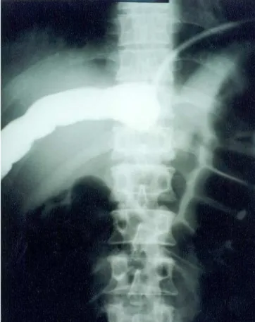 Figure 2 -  Insufflated balloon with iodinated contrast.