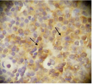 Table 4 demonstrates the correlation between label index and optical density quantification for caspase-3 marker and both groups of patients defined by two grades according to Gleason´s classification: <7 and =7