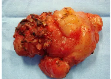 Figure 8 - Pelvic relapse after two years of a rectal GIST resection.