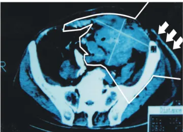 Figure 2 - X-ray part-section of femur at the trochanter, with digital didactic outline of the ischium-pubic branch.