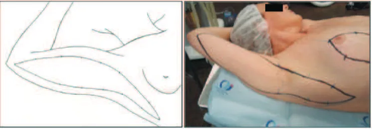 Figure 2 - Marking of the skin in case extending to the chest.