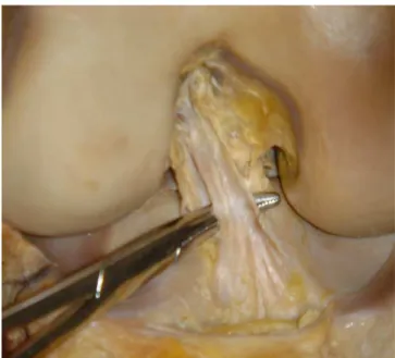 Figure 1 - A) anatomical position and anatomical description, B) surgical position and description proposed by Zantop 17