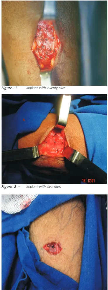 Figure 1- Figure 1- Implant with twenty sites.