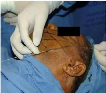 Figure 4 Figure 4 - Postoperative aspect.