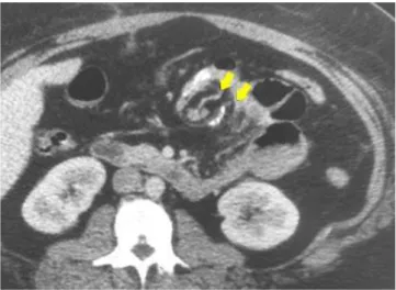 Figure 1 -  Axial CT of the abdomen showing dilated proximal intestinal loop (upper arrows) extending to the level of the anastomosis, demarcated by the suture line (right arrow).