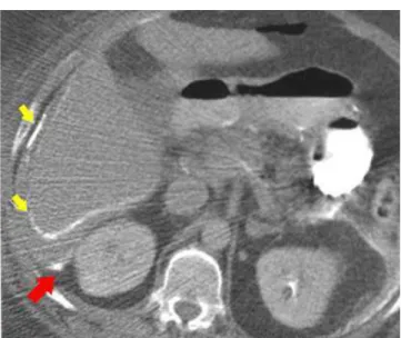 Figure 6 -  Axial CT of the abdomen with fluid collection in the periesplenic region and air-fluid level (abscess) (arrow).