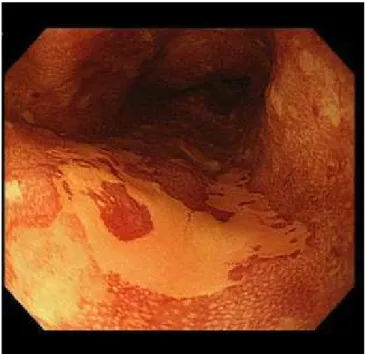 Table 1 shows the electrocautery surgical parameters used for esophagus ESD at Kobe University.