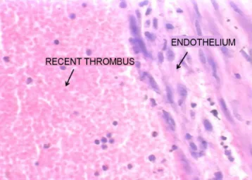 Figure 4 - Histological appearance of the thrombus.