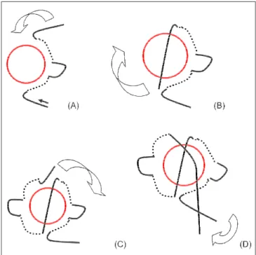 Figure 1 – Scheme of the Sweet technique for closure of the bronchial stump with simple, extramucosal, separated stitches.