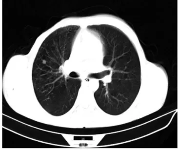 Figure 2 - Computed tomography of the chest showing right lung metastasis.