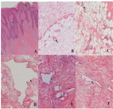 Figure 4 - Figure 4 - A: Skin with irregular acanthosis (two arrows) and fibrosis of skin healing pattern (arrow) - (100x magnification), B, C: Adipose tissue with vascular proliferation (arrows) and interstitial edema (200x magnification), D, F (200x magn