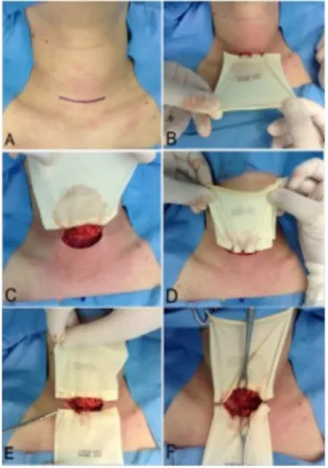 Figure 2 - Incision and fixation of skin protectors. Planning the incision (A); fixing the the upper and lower skin protectors with stitches (B, C, D and E); appearance after fixation of skin protectors (F).