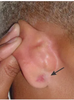 Figure 4 - Aspect of the earlobe after treatment.