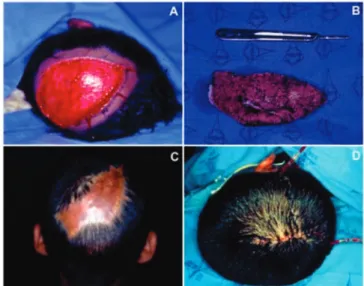 Figura 3.   A) Criança com quatro anos de idade, vítima de mordedura  canina na face e couro cabeludo, submetida à sutura  imedia-ta da lesão; B) Evolução com sete dias de pós-operatório.