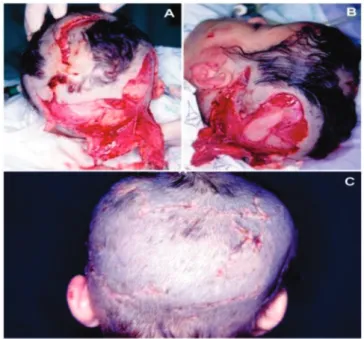 Figure 1.   A and B) Child with extensive scalp lesion due to canine  bite, without loss of substance, subjected to the immediate  closure; C) Postoperative 2-month evolution.
