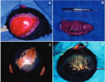 Figure 3.   A four years old child victim of canine bite on the face and  scalp, submitted to immediate lesion suture; B)  postoperati-ve 7-day evolution.
