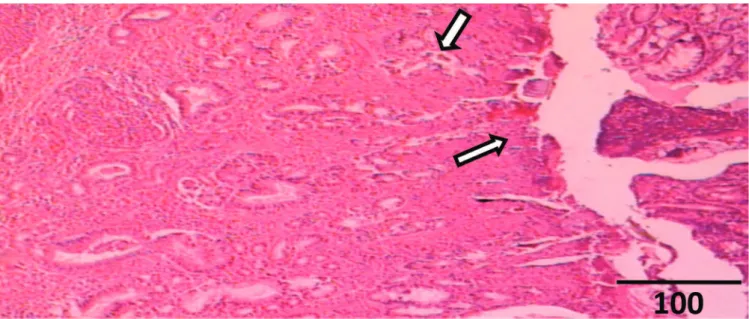 Figure 1.  Presence of neoplasia, with irregularity of the gastric glands, which are not parallel, have different sizes, and forked presentation.
