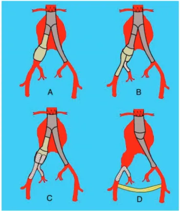 Figure 2.   Endovascular techniques for the treatment of aortoiliac  aneurysms. A) bell-bottom; B) branched iliac endoprosthesis; 