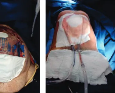 Figure 1.   Bogotá bag technique. Figure 2.   Barker Technique. Figure 3.   Vaccum - Assited Closure – VAC.